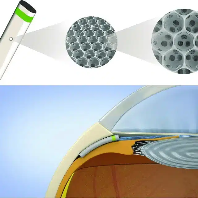 iStar Medical